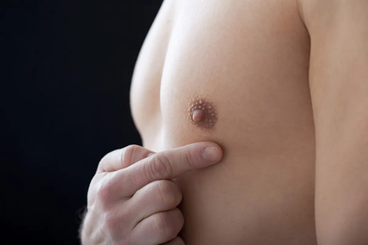 Jinekomasti Ameliyatı Nedir? Erkeklerde Meme Büyümesi Tedavisi